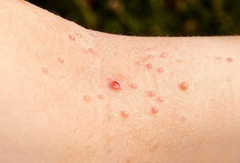 There are many treatments for warts, but often warts go away on their own.