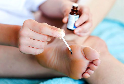 Cantharidin is a medication that is painted onto a wart.