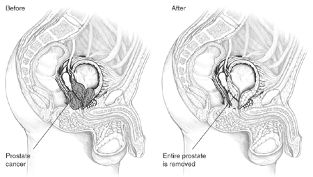 Picture of a radical prostatectomy