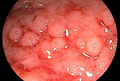 Ulcerative colitis is related to Crohn's disease, another chronic inflammatory disease of the intestines.