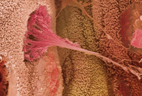 The cause of ulcerative colitis is unknown, but it is believed to be somehow related to abnormal immunologic reactions of the body to the bacteria normally found in the colon. Photo of SEM of ulcerative colitis.