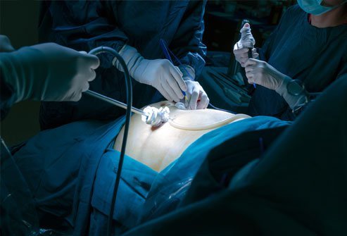 When an organ protrudes through a weak point in the muscle wall or other surrounding tissue, it's called a hernia. 