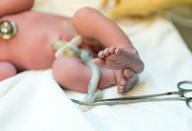 Doctors use an umbilical venous catheter to administer intravenous fluids and medications to a baby.