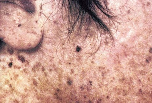 Xeroderma pigmentosum makes it harder for your body to repair damage to skin cells.