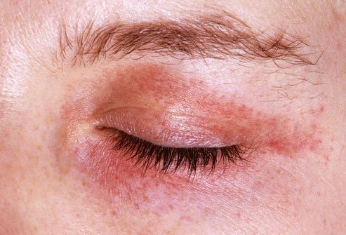 Cutaneous amyloidosis causes a buildup of amyloid in the skin.