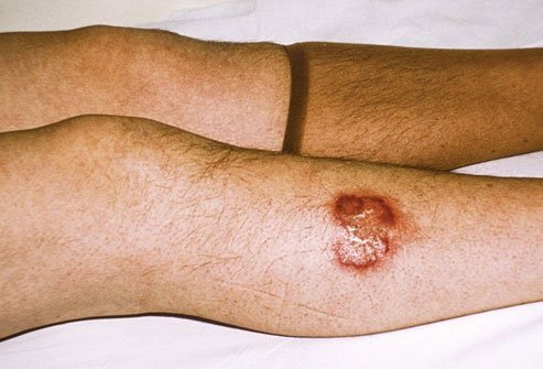 Necrobiosis lipoidica causes skin ulcers, usually on the shins.