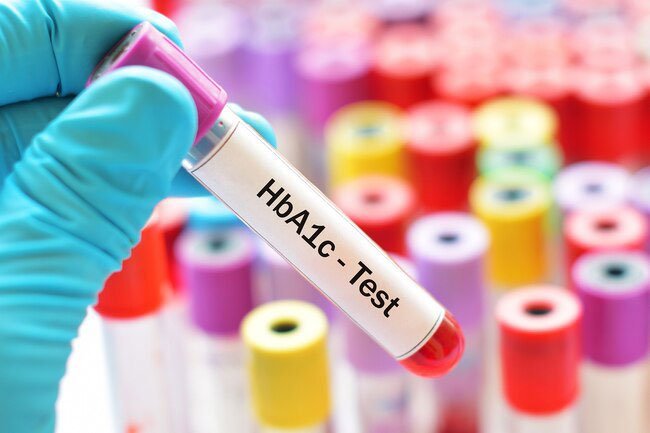 A1c, or Hemoglobin A1c gives a longer-term view of average blood sugar over 2-3 months.