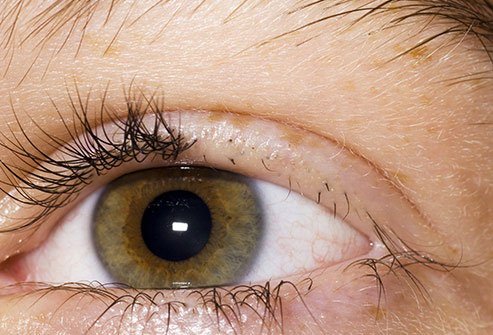 Pulling out eyelashes is one potential sign of trichotillomania. 