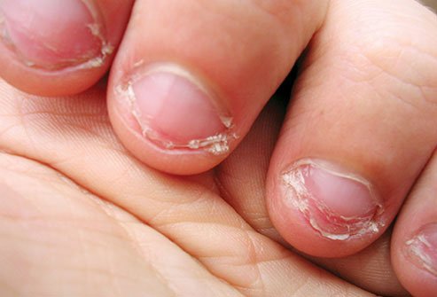 You could hurt yourself and increase the risk of infection by biting your nails. 