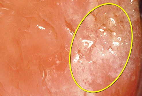 Biting the inside of your mouth may lead to swelling and sores. 