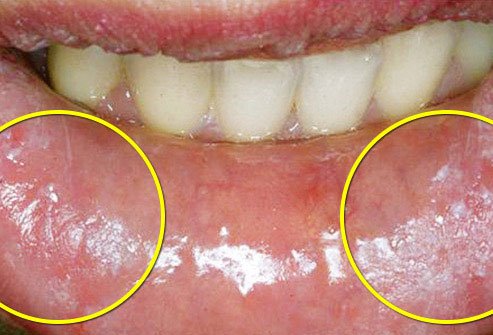 Biting on your inner lip can lead to injury.