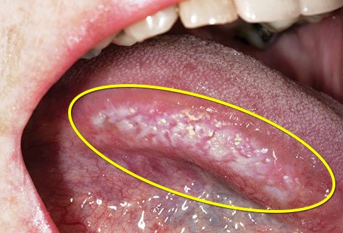 There are devices that help you avoid chewing on the side of your tongue.