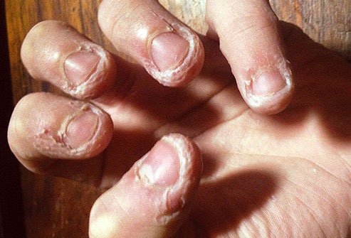 Chewing on your skin to the point of injury is called dermatophagia.