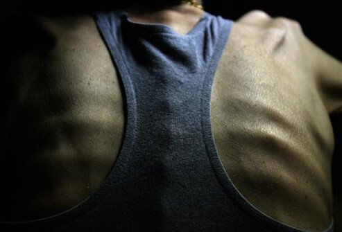 Anorexia nervosa is a condition characterized by an abnormal fear of gaining weight, driving people to starve themselves and become dangerously thin. 