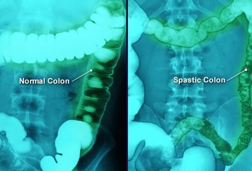 IBS Causes