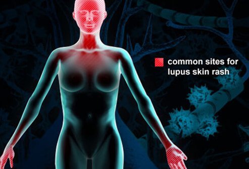 Lupus is an autoimmune disease whereby a misdirected immune system leads to inflammation and injury to one's own body tissues.