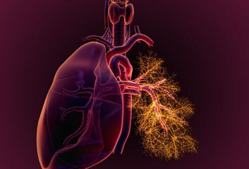 Inflammation of the tissue around the lungs is called pleuritis.