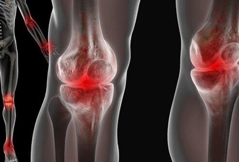 Though the first signs of the lupus disease can be rash, there are often pains in the muscles and joints.
