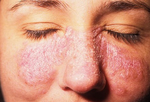 A classic lupus rash involves the cheeks and over the bridge of the nose.