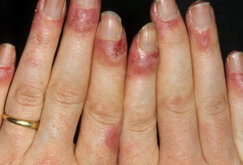 Lupus rash can cause a ruddy discoloration of the backs of the hands and fingers.