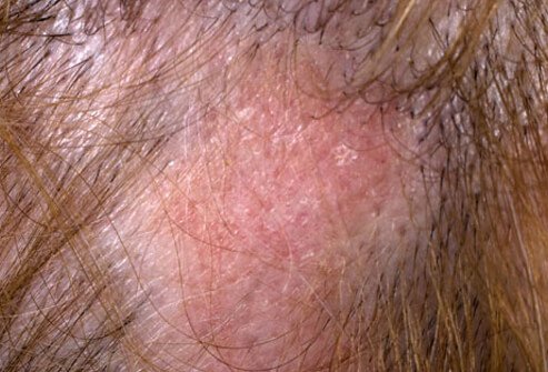 Symptoms of lupus tend to wax and wane.