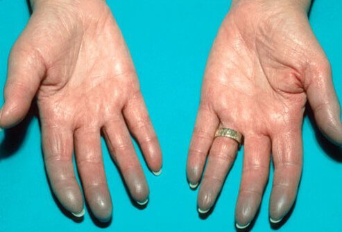 Some patients with lupus have Raynaud's phenomenon.