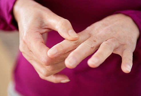 Initially, lupus that affects the joints can mimic rheumatoid arthritis.