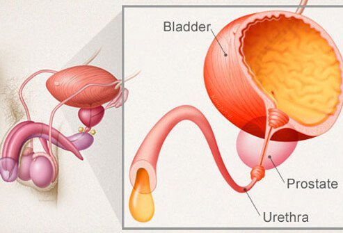 What Causes Male Incontinence?