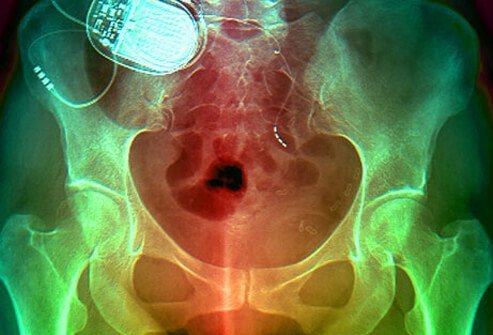 Nerve Stimulation through implants or Botox injections are additional treatments to treat incontinence.