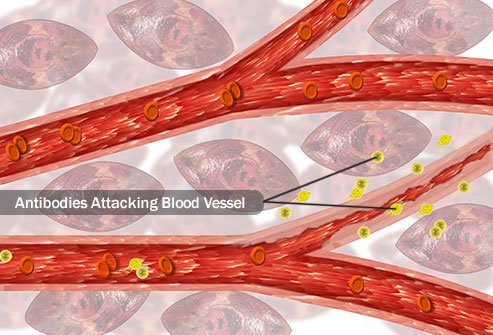Sometimes high levels of proteins in your pee indicate vasculitis.