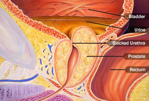 Blockages in your urinary tract may show up in urine tests.