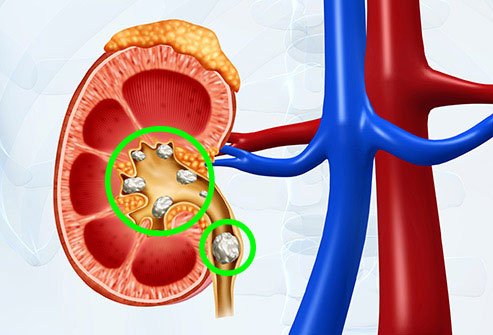 Painful kidney stones can be identified through urinalysis.