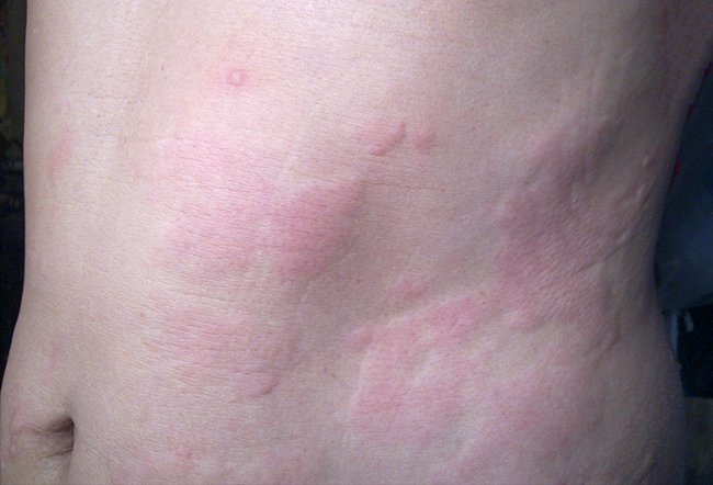 Aquagenic urticaria or aquagenic pruritus is a rare dermatological condition. There is no cure for aquagenic pruritus, but it is treated with oral medications, phototherapies, TENS, topical creams and by adding sodium bicarbonate to bath water.