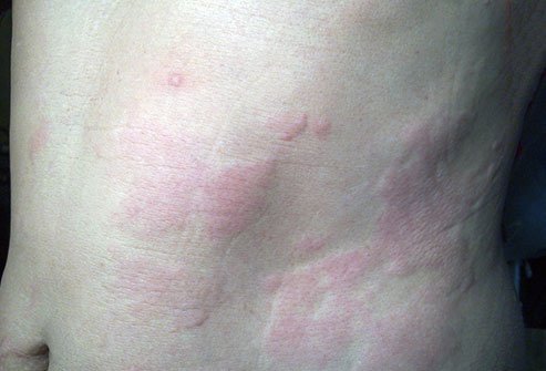 Hives are itchy bumps that appear on your skin, usually as a result of an allergic reaction. Some cases of hives have no known cause.
