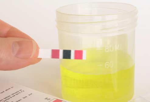 Urinalysis is a urine test that can be used to detect infection (white blood cells) or bleeding (red blood cells).