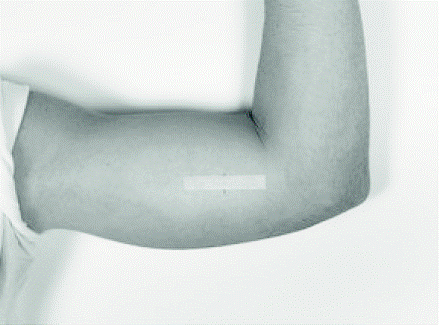 Mean Serum Total Testosterone Concentrations (+SD) for All Patients (n=138) Who Received One VANTAS Implant. (Note that in this
group, sampling began at the end of Week 1.) - Illustration