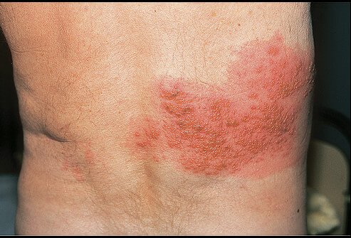 Picture of Varicella-Zoster Virus Infection on Chest Wall  