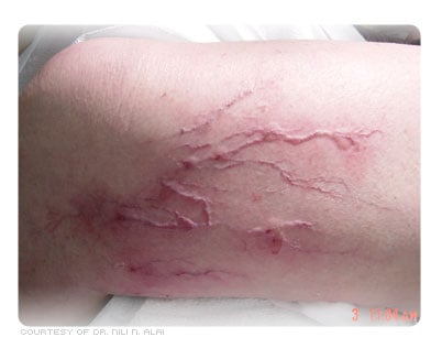 Picture of Varicose Veins