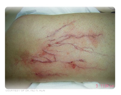 Picture of Spider Veins Being Treated with Sclerotherapy