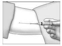 Inserting the Implant - Illustration  1