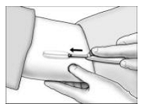 Inserting the Implant - Illustration 3