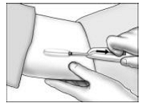 Inserting the Implant - Illustration 4