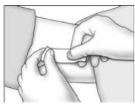 Inserting the Implant - Illustration 5