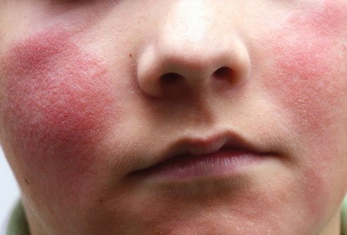 Fifth disease causes one of the most common viral skin rashes in children. 