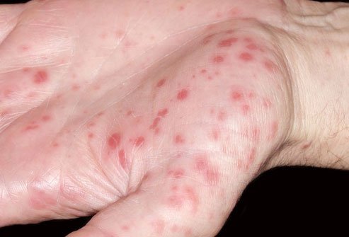 Hand-foot-and-mouth disease causes a painful, self-limiting rash on these areas. 