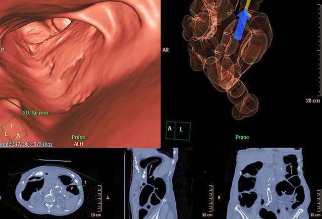 Virtual colonoscopy is a technique that uses a CT scan to construct virtual images of the colon.