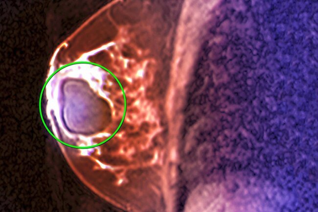 Breast cysts are common benign breast lumps.