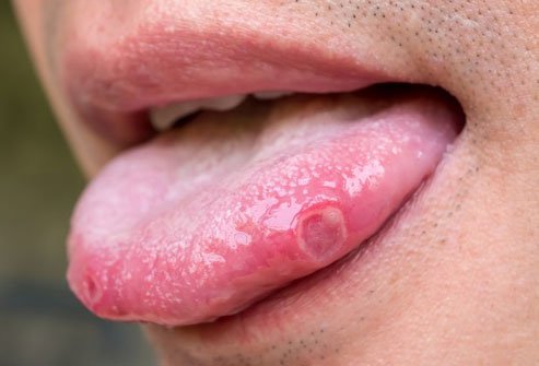 Lack of B12 can cause mouth sores.