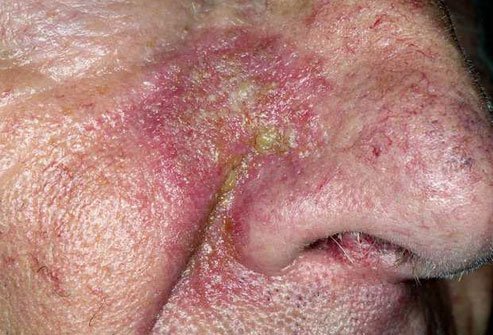 Signs that you lack B6 can show up on your skin.