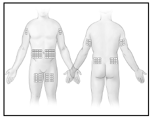Areas recommended for subcutaneous infusion - Illustration